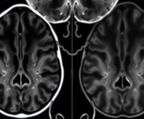 Цель МРТ спинного мозга